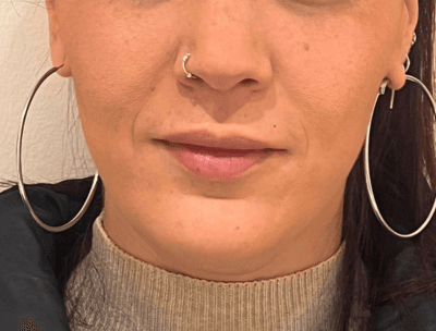 ANTES – Hidratación y definición de labios
