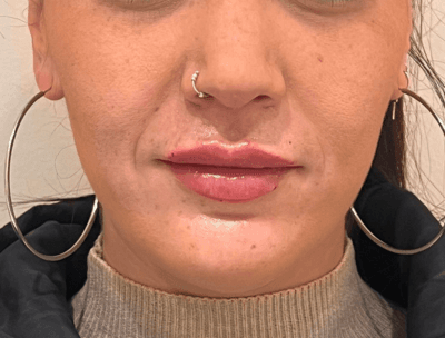 DESPUÉS – Hidratación y definición de labios
