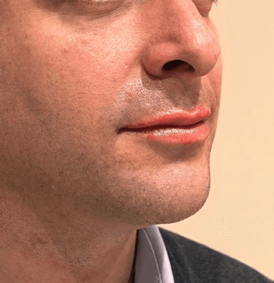 DESPUÉS – Hidratación de labios
